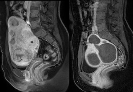 3th month follow up uterine artery embolization-mutlucihangiroglu.com.jpg